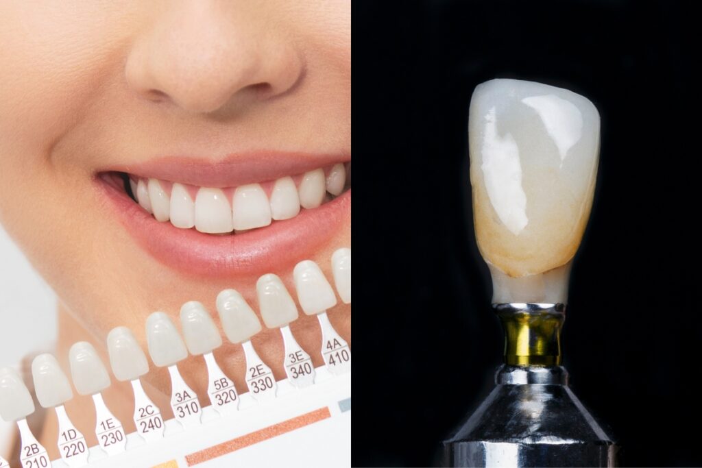 Difference Between Dental Veneers and Dental Crowns